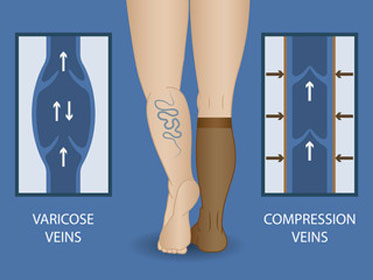 Compression Theraphy